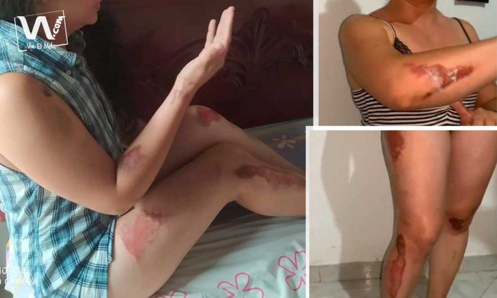 «Sentí mi cabeza rebotar en el asfalto»: víctima de raponazo en Villavicencio