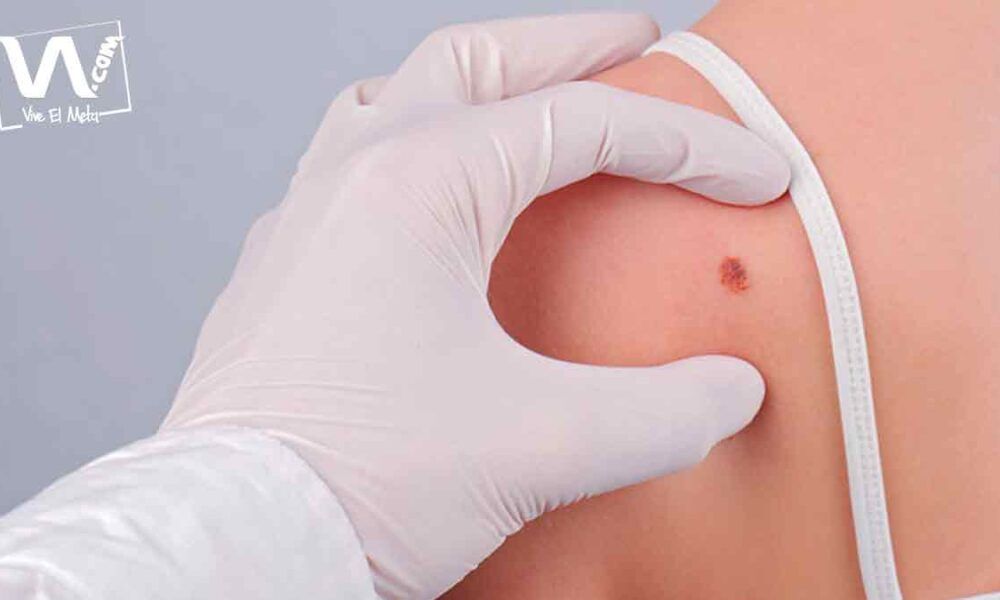 Piden prevención por aumento de casos de cáncer de piel en Villavicencio