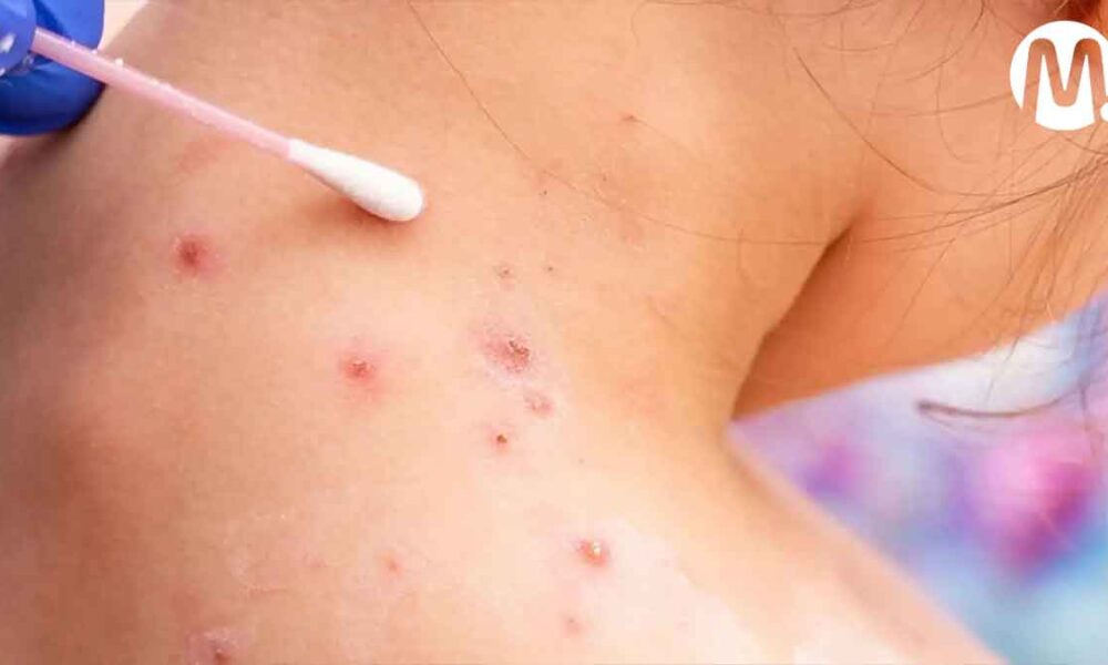 Reportan seis nuevos casos de viruela del mono en Villavicencio
