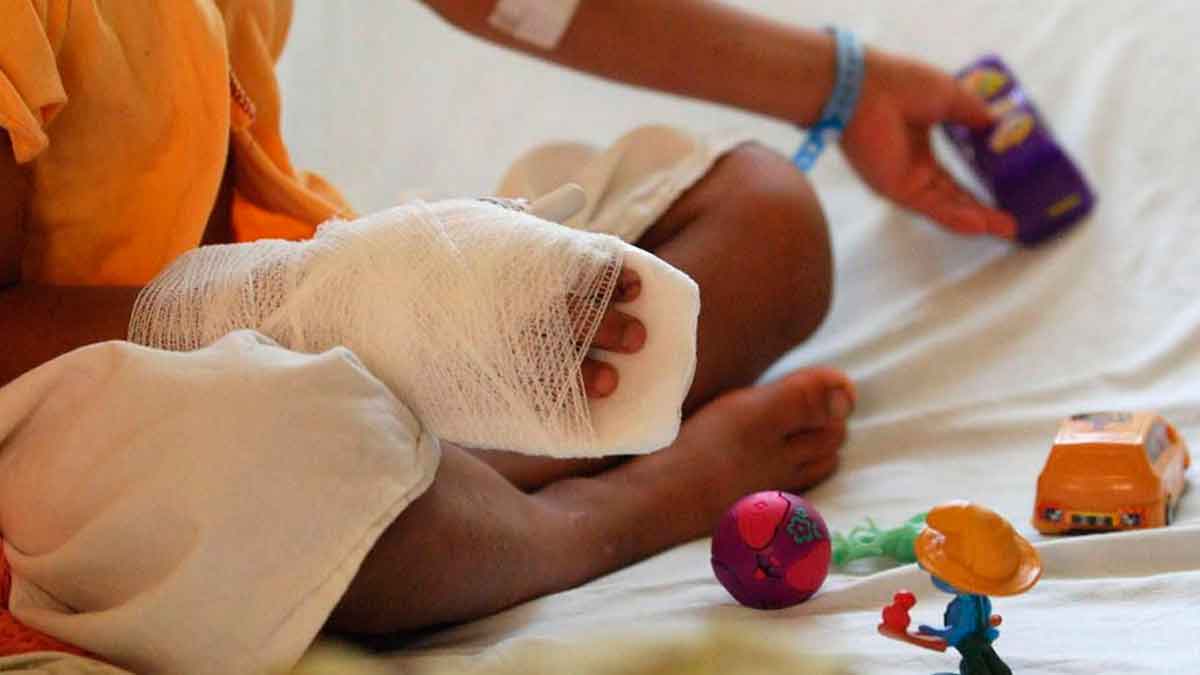 Alerta nacional por quemados con pólvora: el Meta reporta siete casos