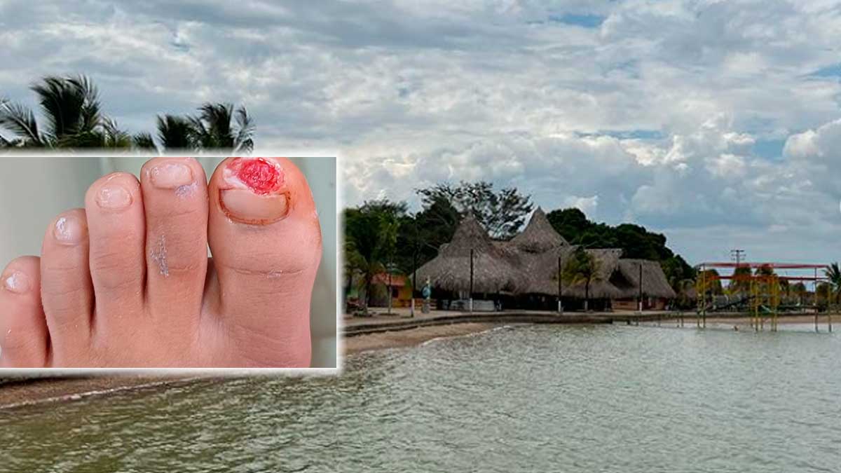 Historia clínica confirma que niño fue mordido por una piraña en lago del parque Merecure