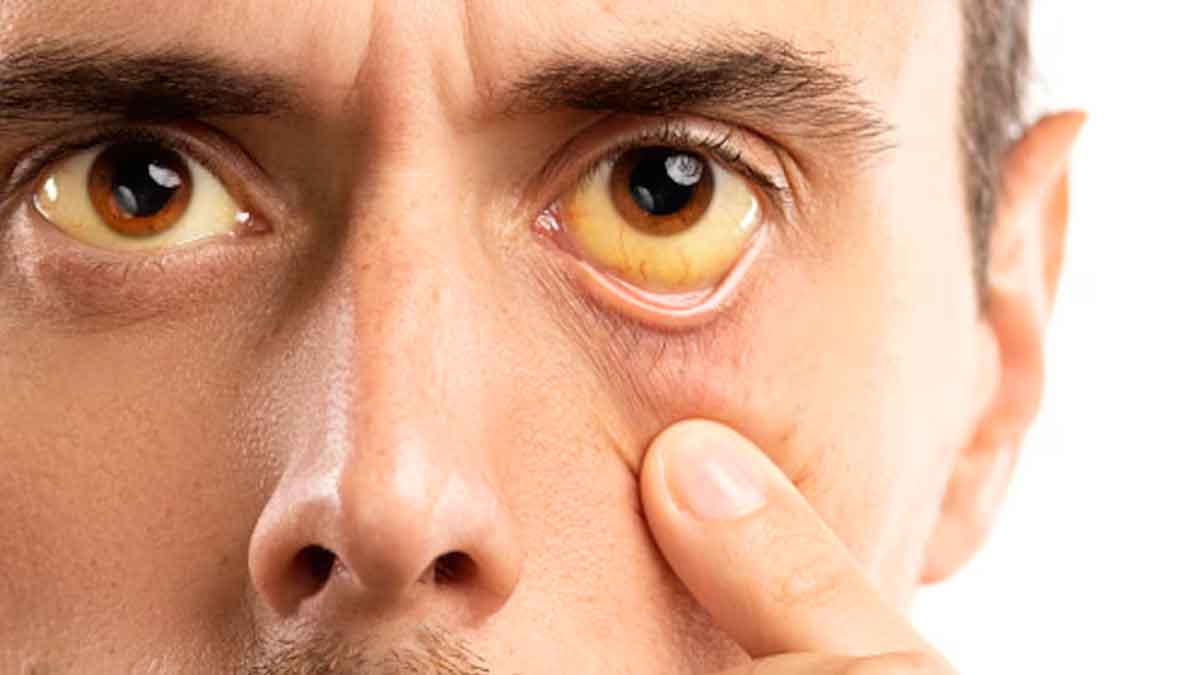 Fiebre amarilla cobró una vida en el Meta: autoridades declaran alerta sanitaria