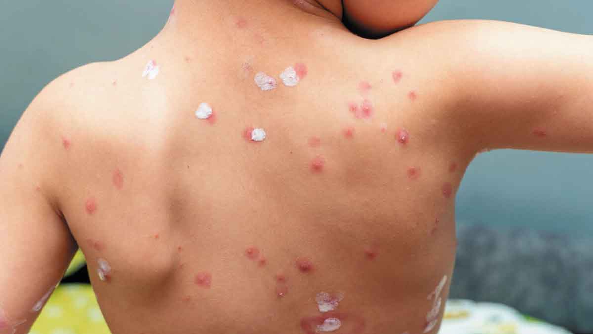 Autoridades de salud alertan por brote de varicela en colegio de Villavicencio