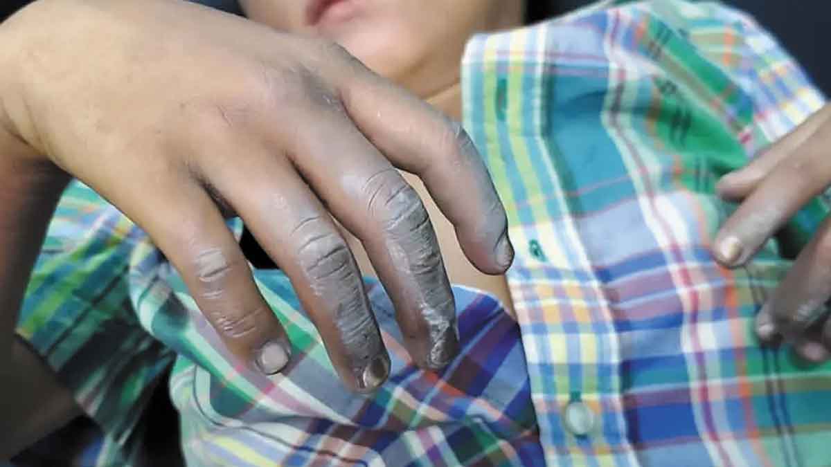 Un niño de 7 años es la primera víctima de quemadura por pólvora este año en Villavicencio
