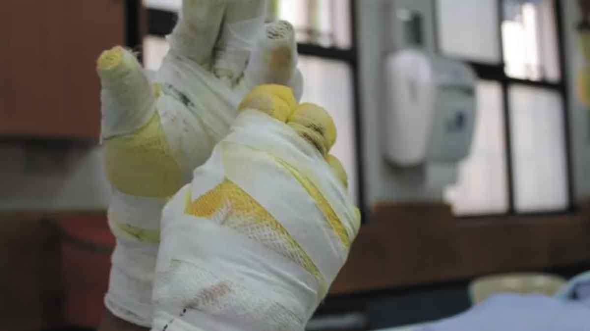 Un adulto amputado y una menor quemada por pólvora dejó la celebración de Navidad en Villavicencio