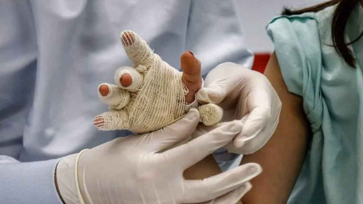 Uso de pólvora deja 25 personas lesionadas durante el cierre e inicio de año en el Meta